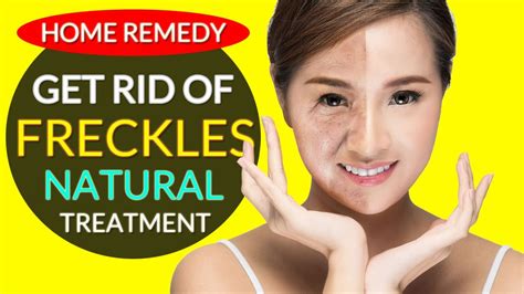 Best Freckle Removal Treatment | How to Get Rid of Freckles at Home - YouTube