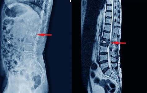 Compression fracture spine - tennisryte