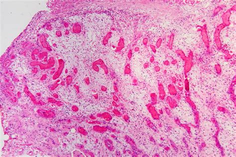 File:Granulation tissue in an infected wound, HE 1.JPG - Libre Pathology