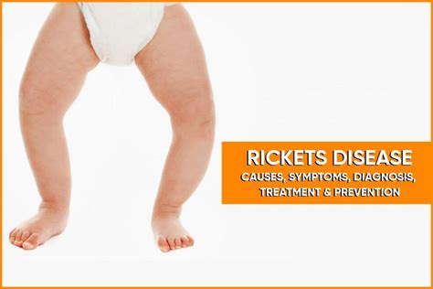 RICKETS DISEASE – CAUSES, SYMPTOMS, DIAGNOSIS, TREATMENT & PREVENTION - Dr Rajeev Nirawane