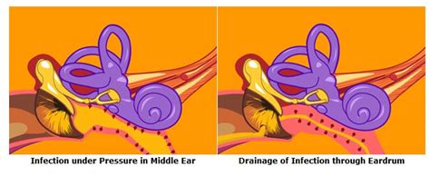 Otitis Media (Middle Ear Infections) | ENT & Allergy of Delaware