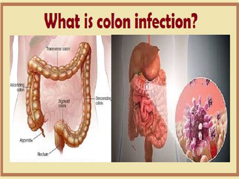 Names Of Intestinal Infections