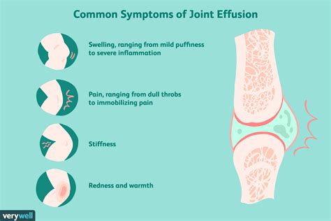 Joint Effusion: What It Is, Symptoms, Treatment