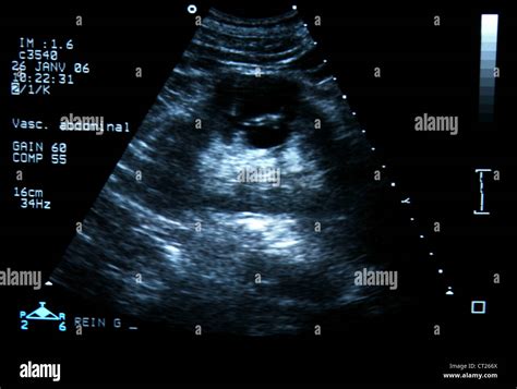 Renal Cyst Ultrasound