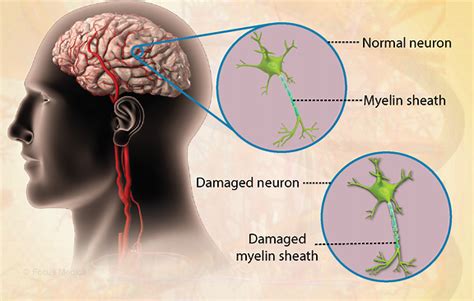 Health Condition : Symptoms, Causes, Treatment and More