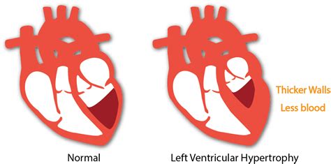 Cardiac Hypertrophy Research | Ventricular Pressure-Volume (PV) Analysis | ADInstruments