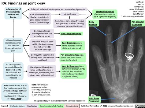 Rheumatoid arthritis (RA): X-ray features | Calgary Guide