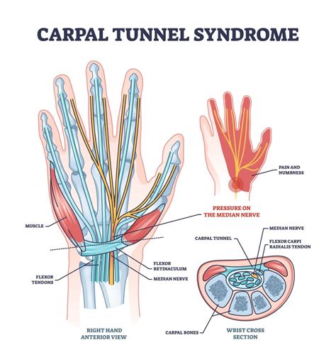 Pregnancy and Carpal Tunnel Syndrome - Giggle Magazine