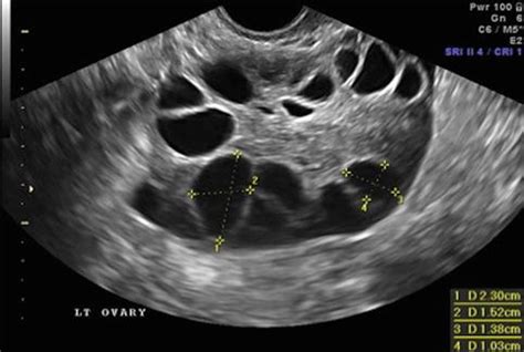 Ovarian Follicle Ultrasound