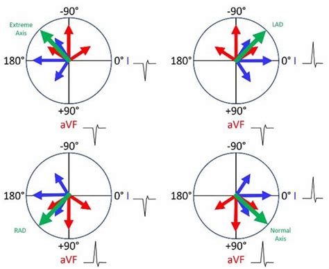 Heart left axis deviation causes, symptoms & treatment