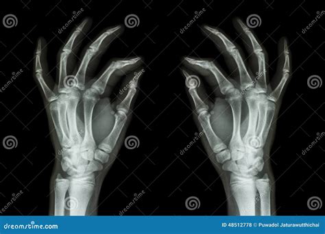 X-ray Normal Human Hands (front) On Black Background Stock Photo - Image of medicine, orthopedic ...