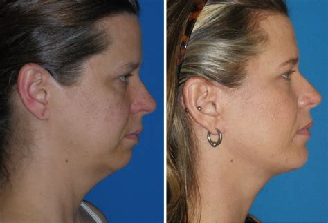 Chin Implants: The Fastest Growing Cosmetic Surgery Procedure!