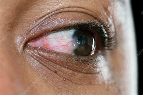 Pterygium eye disorder - Stock Image - C037/5113 - Science Photo Library