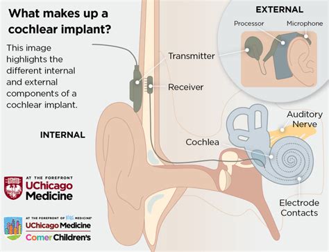 Cochlear Implant Surgery