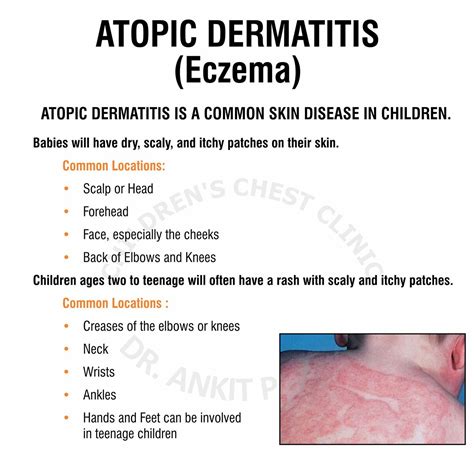 Atopic Dermatitis Eczema - Dr. Ankit Parakh