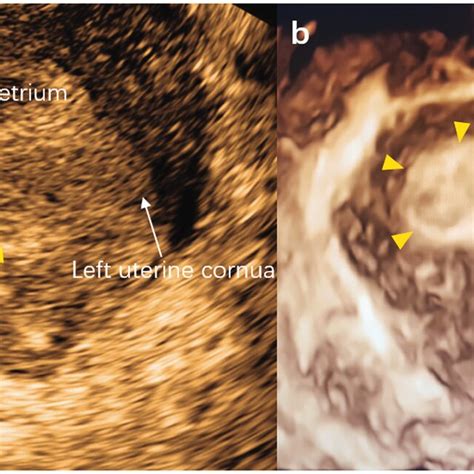 Laparotomic view of our case of myomectomy scar pregnancy. (a) Bulging... | Download Scientific ...