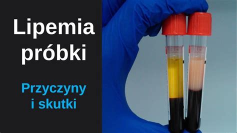 Lipemia (zmętnienie) próbki -Co znaczy surowica lipemiczna? | Lipemia turbidity sample lipemic ...