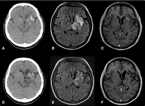 An adult case of cerebral malakoplakia successfully cured by treatment with antibiotics ...