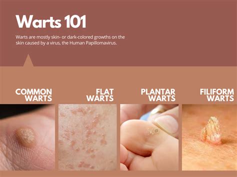 Warts: Signs & Symptoms - Dermatology Physicians Group Chicago Illinois