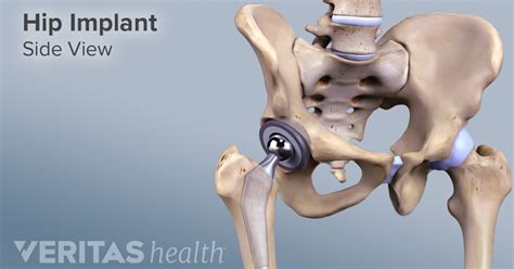 Osteoarthritis Hip Replacement - designsonskills