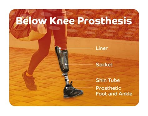 Leg Prosthesis Types