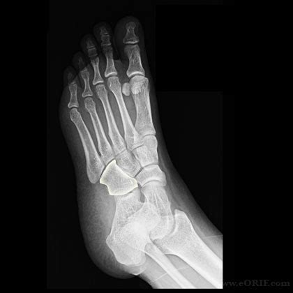 Cuboid Fracture S92.213A 825.23 | eORIF