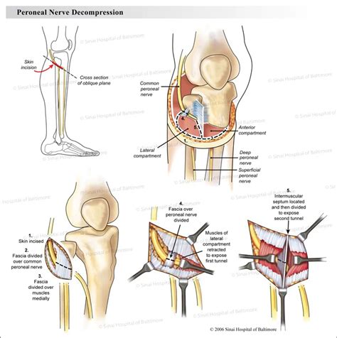 Common Peroneal Nerve