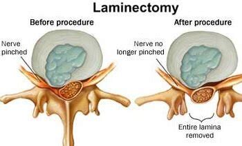 What Is A Hemilaminectomy - mapasgmaes