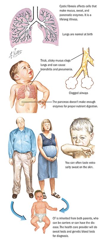 Cystic Fibrosis Symptoms : Cystic Fibrosis Case Study new / The cystic ...