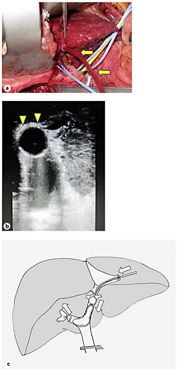 Surgical view. A balloon catheter (arrows) was introduced via the... | Download Scientific Diagram