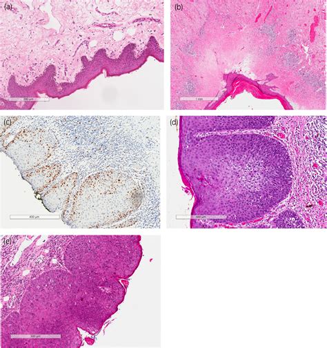 Erythroplasia Of Queyrat Histology