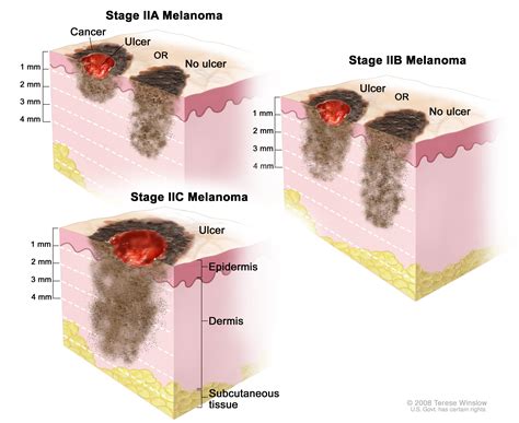 Treatments For Skin Cancer Melanoma | Woman and Girls