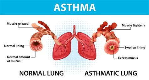 Bronchial Asthma diagram with normal lung and asthmatic lung 3567446 ...