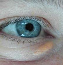 Xanthelasma Palpebrarum – Doctor V.