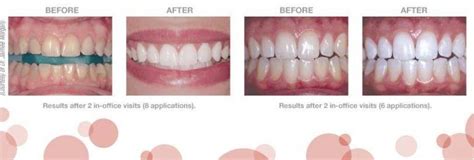 Opalescence Whitening With Peroxide 16% 20% Kit Ultradent, 54% OFF