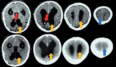 Hydrocephalus On CT Scan