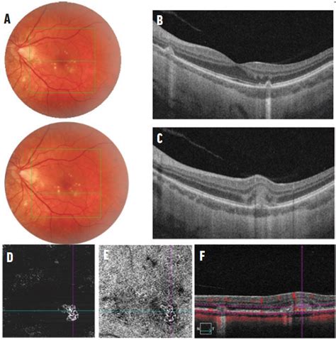 Clinical Utility of OCT Angiography for Retinal and Choroidal Vascular ...