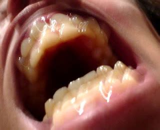 Gum Abscess: Prevention to treatment of abscess in gums - TeethSmiling