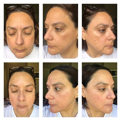 6 weeks on Musely veteran .1% tretinoin and spot cream m+. Lots of ...