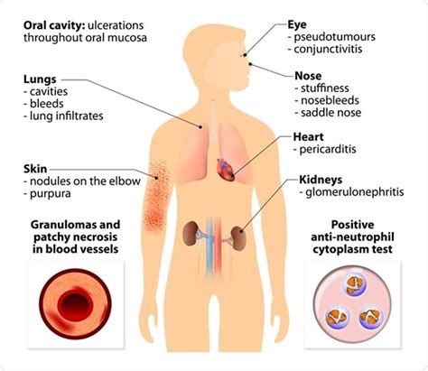 What is Granulomatosis with Polyangiitis?