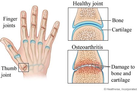 Hand Osteoarthritis