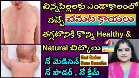 Heat Rashes Home Remedies|Home Remedies For Pinkly Heat Rashes In Kids ...
