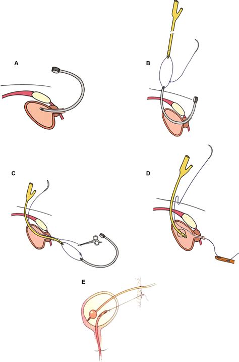 Urostomy Suprapubic Catheter