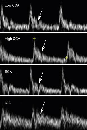 Normal Carotid Artery Ultrasound