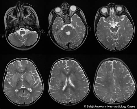 Dr Balaji Anvekar FRCR: Measles Encephalitis MRI