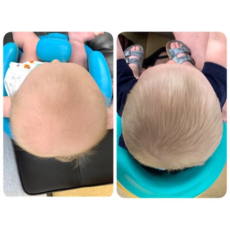 About Plagiocephaly – Children's Orthotics and Prosthetics