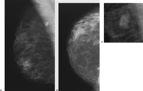 Calcifications: Dystrophic | Radiology Key