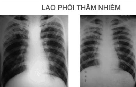 Xquang trong chẩn đoán lao phổi | BvNTP