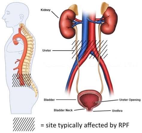 Retroperitoneal fibrosis (RPF) - overview - Chronic Kidney Disease Explained