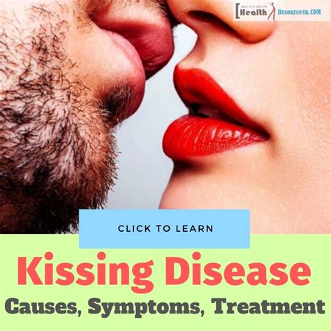 Kissing Disease : Causes, Symptoms, Treatment Of Mononucleosis